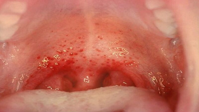 Viêm họng xung huyết ở trẻ em và những điều cần biết về căn bệnh này!