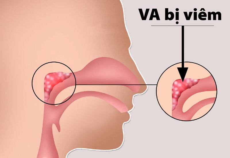 Giải đáp thắc mắc: Trẻ mấy tuổi thì nạo VA?