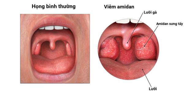 Bệnh tai mũi họng: Điểm danh những căn bệnh phổ biến hiện nay!