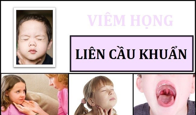 Viêm họng liên cầu ở trẻ em và 3 vấn đề phụ huynh cần nắm rõ