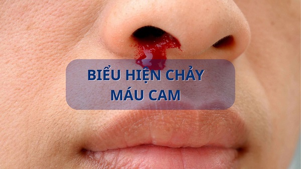 Chảy máu mũi một bên là do đâu? Cách xử trí và khi nào cần đi khám?