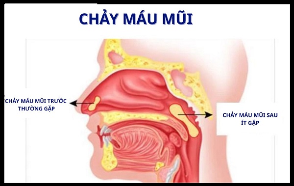 Chảy máu mũi: Cảnh báo dấu hiệu bất thường không nên chủ quan