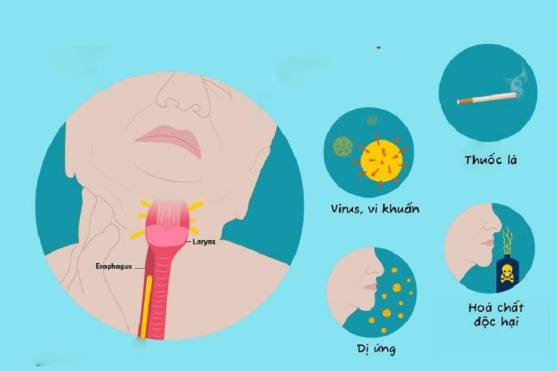 Toàn bộ thông tin quan trọng về bệnh viêm họng mà mọi người cần phải biết