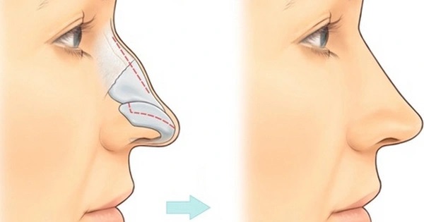 Gãy xương mũi: Dấu hiệu nhận biết, biến chứng nguy hiểm và cách xử lý đúng cách