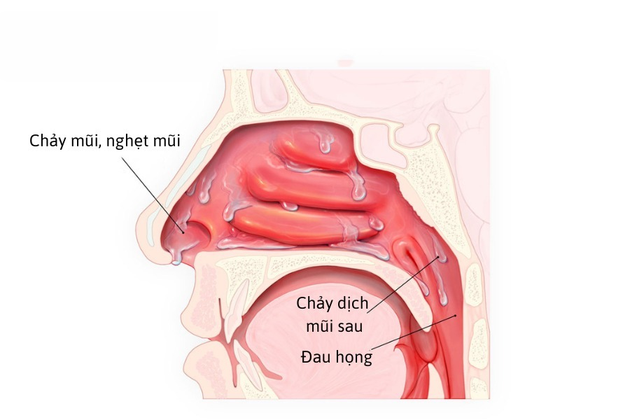 Tại sao bạn bị chảy mũi, sổ mũi, hắt hơi? Tìm hiểu nguyên nhân ngay!