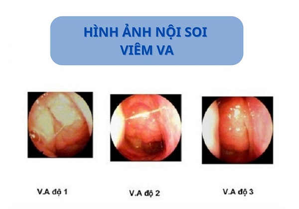 Giải mã viêm VA độ 1 – Giai đoạn nhẹ nhưng không nên chủ quan