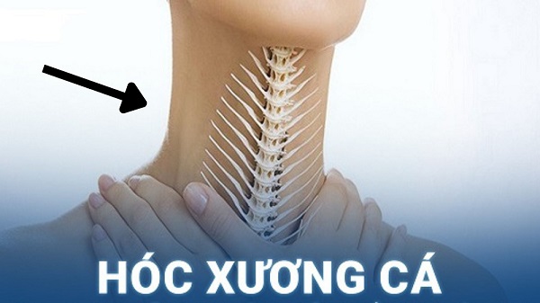 Bị hóc xương cá? Đây là những lý do bạn không nên chữa hóc xương cá tại nhà