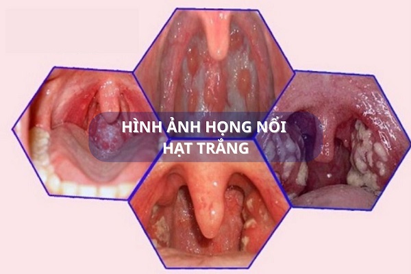 Họng nổi hạt trắng có nguy hiểm không? Khi nào cần đi khám gấp?