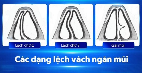 Chuyên gia cảnh báo nguy hiểm khi mũi bị lệch vách ngăn!