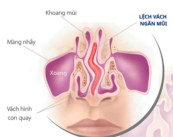 Điều trị lệch vách ngăn mũi hết bao nhiêu tiền? Cập nhật chi tiết & thực tế 2025