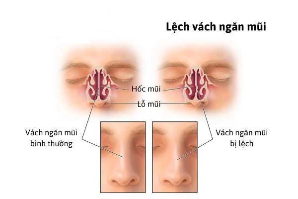 Chuyên gia cảnh báo nguy hiểm khi mũi bị lệch vách ngăn!