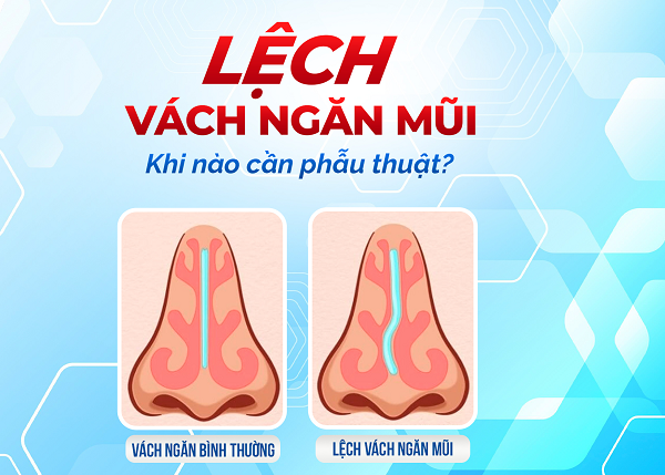 Phẫu thuật lệch vách ngăn mũi – bạn hiểu gì về thủ thuật này?