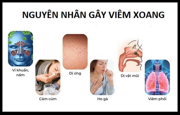 Viêm xoang: Nguy hiểm không chỉ là nghẹt mũi