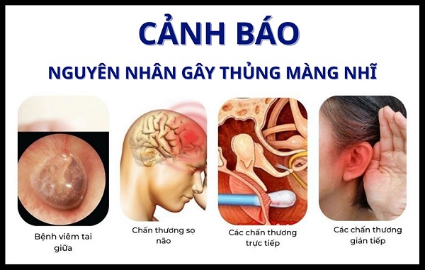 Màng nhĩ rách: Lành được không? Bao lâu lành? Khi nào cần gặp bác sĩ?