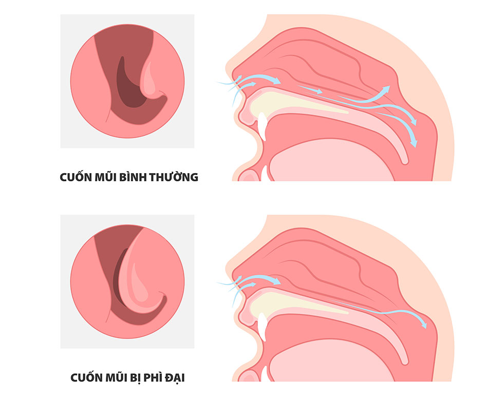 Viêm mũi phì đại – Đừng để “căn bệnh quen mặt” làm phiền cuộc sống bạn mỗi ngày!