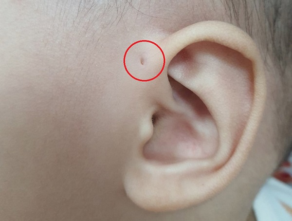 Dị tật rò luân nhĩ và những điều quan trọng bạn cần biết!