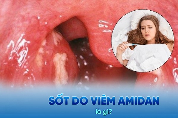 [GÓC HỎI ĐÁP] Viêm amidan gây sốt có nguy hiểm không?