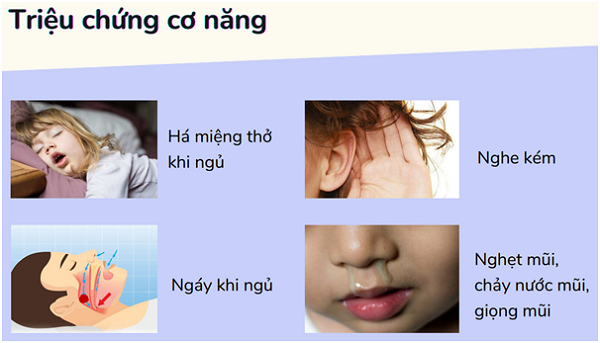 Viêm VA mãn tính – Bệnh lý tuyệt đối không được chủ quan ở trẻ nhỏ