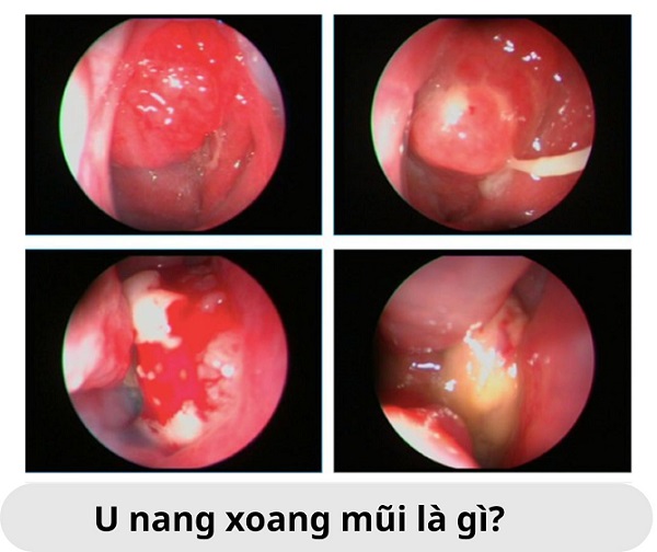 U nang xoang mũi – Phát hiện sớm, điều trị nhẹ nhàng tại Bắc Ninh
