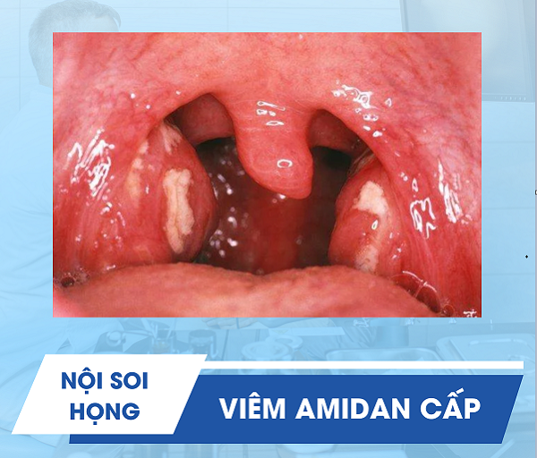 Không thể chủ quan với bệnh lý viêm amidan cấp – Nguy hiểm tiềm ẩn!