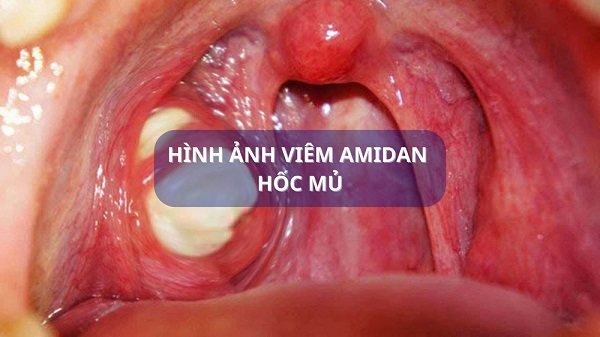 Tổng hợp thông tin từ A-Z về viêm VA hốc mủ