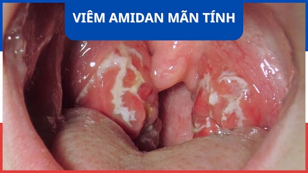 [TIẾT LỘ] Chi phí nạo amidan hết bao nhiêu tiền?