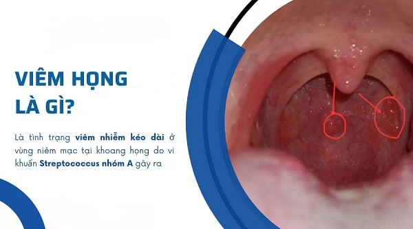 Đau họng kéo dài là do đâu? 5 bệnh này có thể là thủ phạm