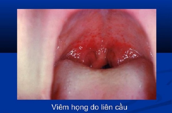 Viêm họng liên cầu ở trẻ em và 3 vấn đề phụ huynh cần nắm rõ