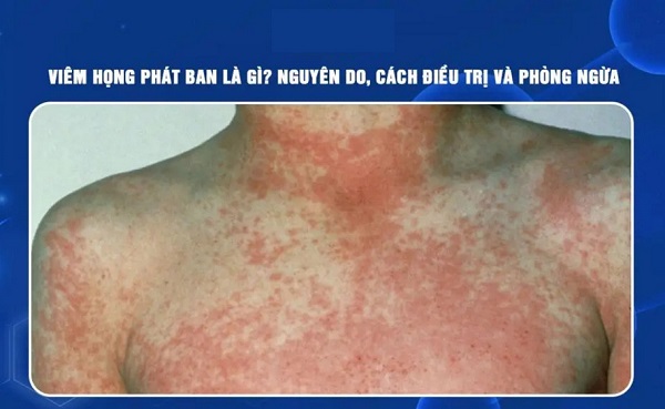 [GÓC CHIA SẺ] Xử lý viêm họng phát ban ở trẻ như thế nào?