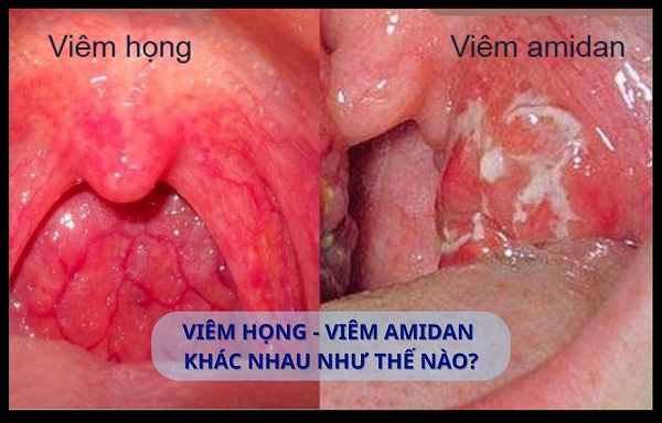 Viêm amidan và viêm họng hạt khác nhau chỗ nào? Làm sao biết mình đang mắc bệnh gì?