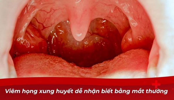 Viêm họng xung huyết ở trẻ em và những điều cần biết về căn bệnh này!