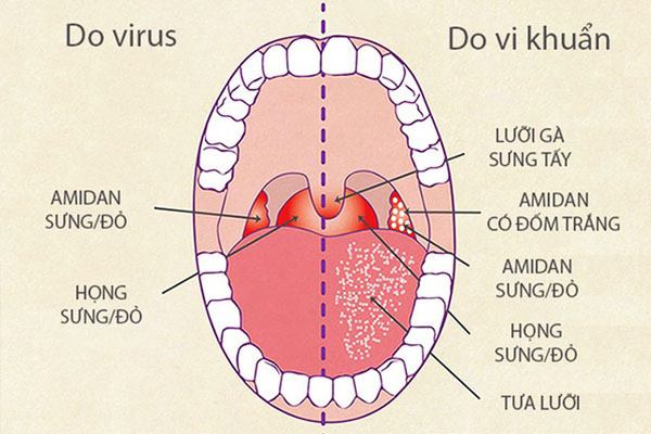 Viêm họng tái đi tái lại – phải chữa viêm họng thế nào để hạn chế tái phát?
