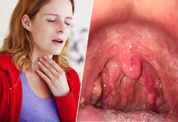 Toàn bộ thông tin quan trọng về bệnh viêm họng mà mọi người cần phải biết