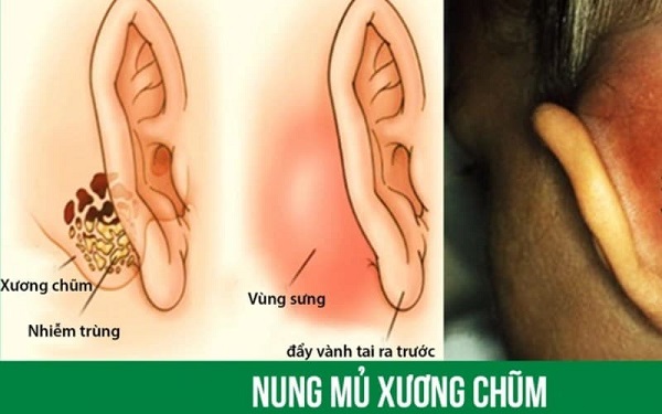 Hiểu hết về viêm tai xương chũm để phát hiện sớm và điều trị kịp thời