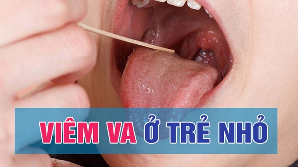 Viêm VA cấp độ 4: Cảnh báo khẩn cha mẹ không nên bỏ qua
