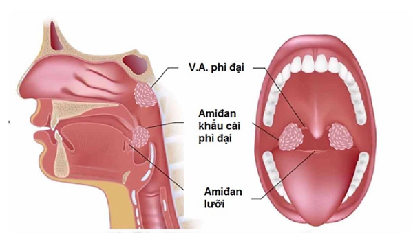Bạn biết gì về bệnh lý viêm VA phì đại? Làm sao để khắc phục bệnh nhanh chóng?