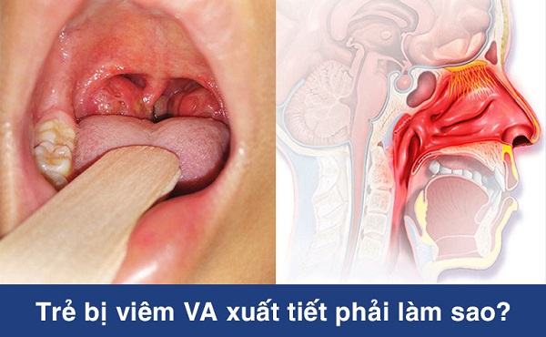 Bị viêm VA xuất tiết – Dấu hiệu cảnh báo bệnh lý viêm VA đã diễn biến nặng