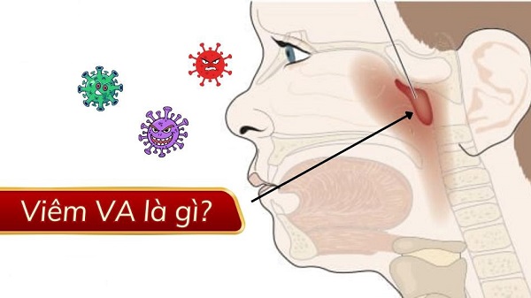 Viêm VA là gì mà khiến hàng triệu em mất ngủ mỗi đêm?