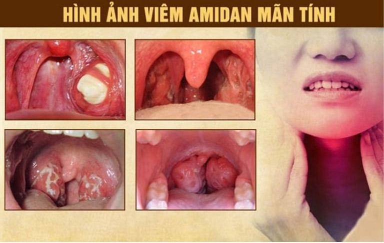 Tìm hiểu: Phẫu thuật viêm amidan có áp dụng cho mọi trường hợp?
