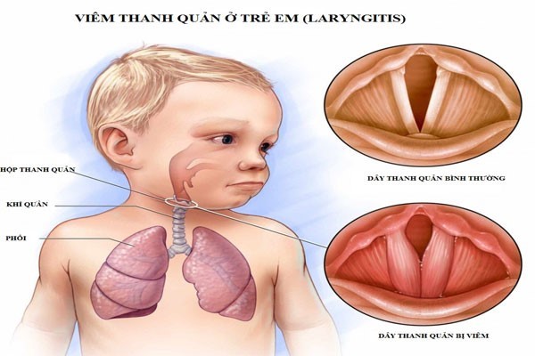 Dấu hiệu nhận biết viêm thanh quản cấp – Điểm danh 05 triệu chứng điển hình!