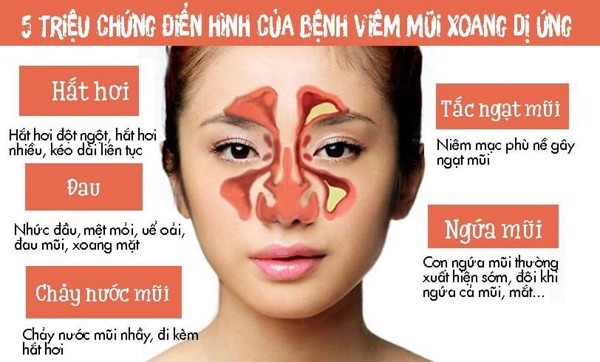 Hiểu đúng về viêm xoang dị ứng để điều trị hiệu quả và ngăn tái phát