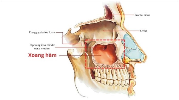 Làm gì khi bị viêm xoang hàm? Đâu là giải pháp khắc phục nhanh chóng?
