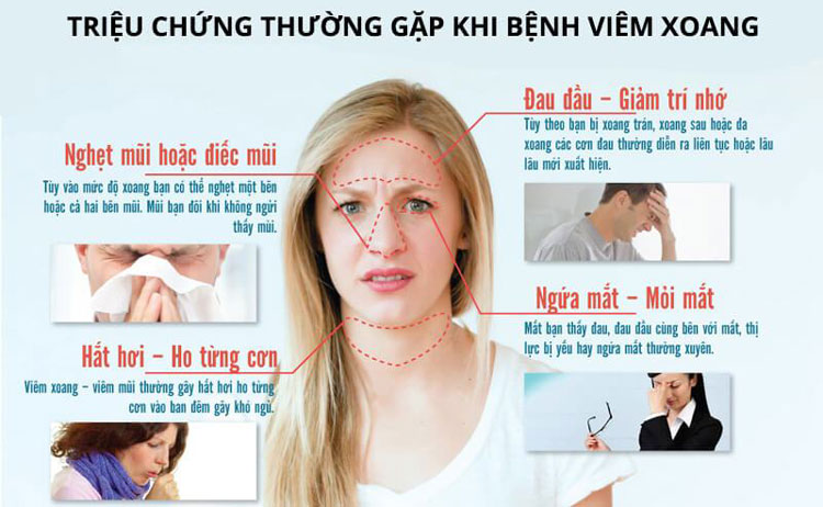 Bác sĩ chuyên khoa chỉ ra những dấu hiệu nhận biết viêm xoang cấp điển hình