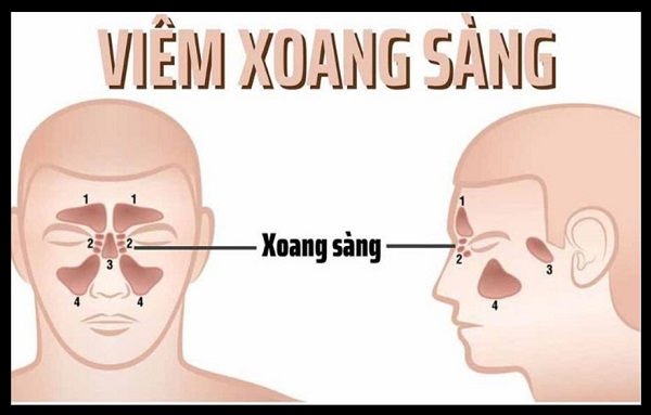 Tất tần tật về viêm xoang sàng – Những điều bạn cần biết!