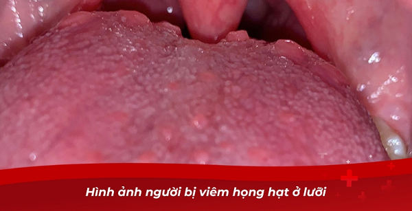 Viêm họng hạt ở lưỡi: Nhận biết kịp thời – Điều trị đúng cách – Hạn chế biến chứng