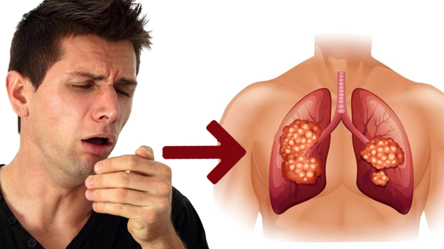 Giải mã tình trạng ho kéo dài và biện pháp xử lý hiệu quả