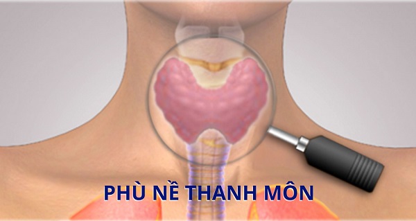 Tìm hiểu về phù nề thanh môn và biện pháp điều trị bệnh hiệu quả
