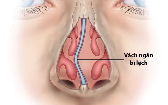 Giải đáp thắc mắc: Nghẹt mũi một bên kéo dài có phải lệch sống mũi?
