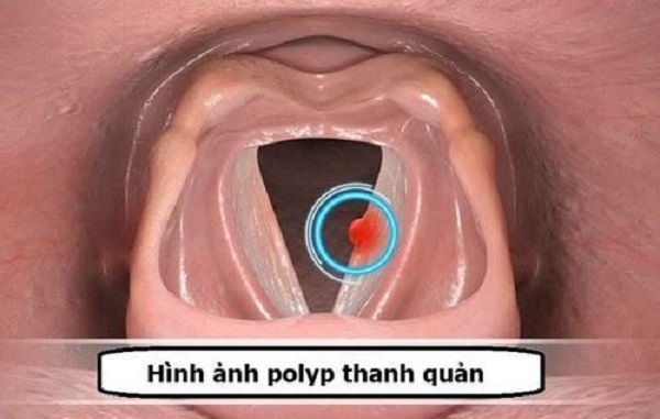 TÌM HIỂU: Polyp dây thanh và hạt xơ dây thanh khác nhau thế nào?
