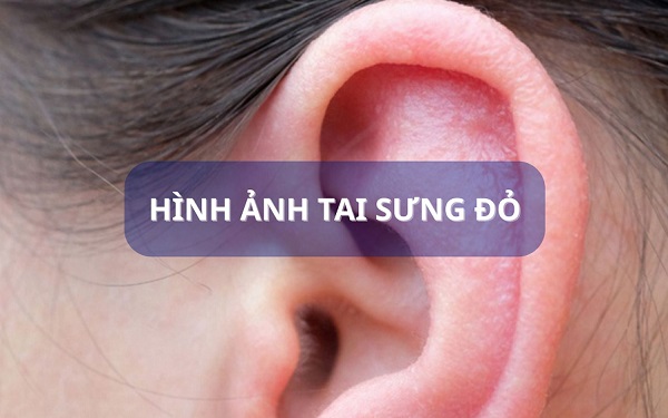 [BỆNH NHÂN HỎI – BÁC SĨ TRẢ LỜI] Tai bị sưng đỏ và đau là bệnh gì?